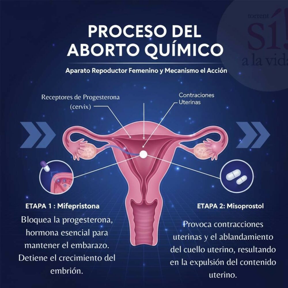 Infografía del proceso del aborto químico con mifepristona y misoprostol, mostrando receptores de progesterona y contracciones uterinas.